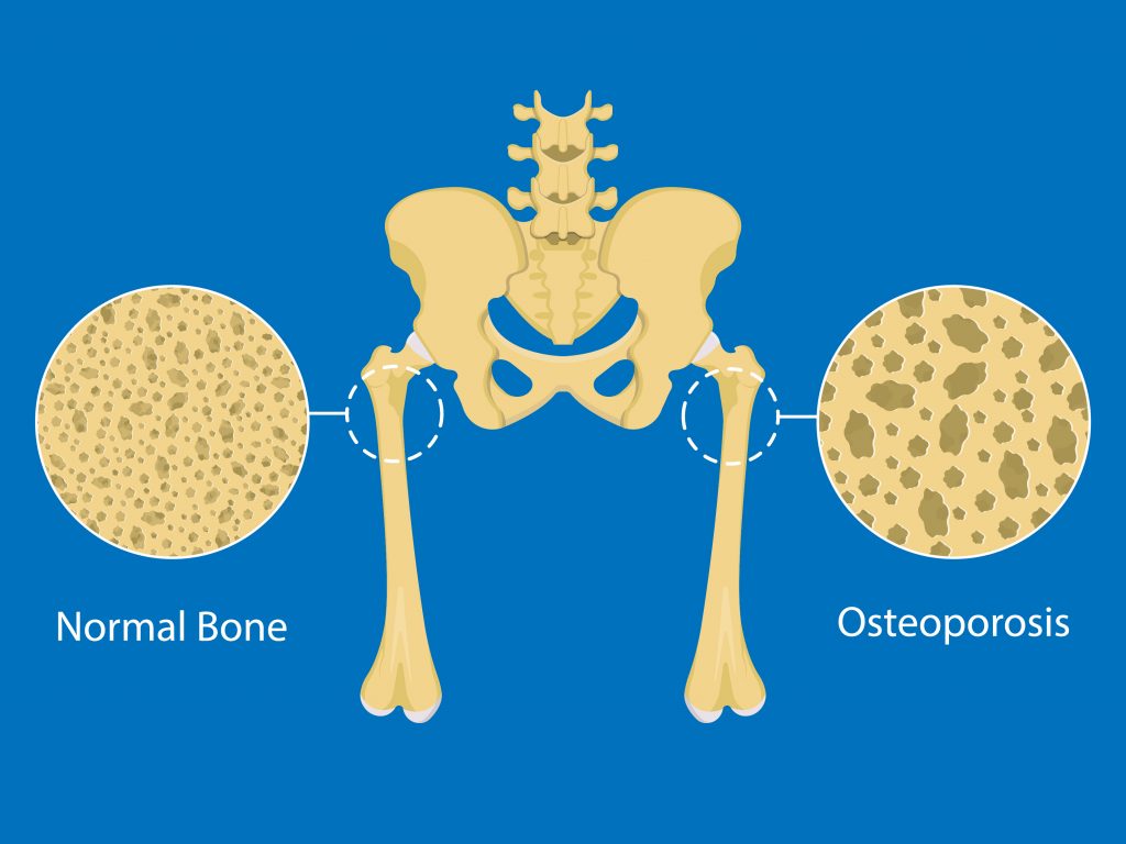 How To Check Bone Density