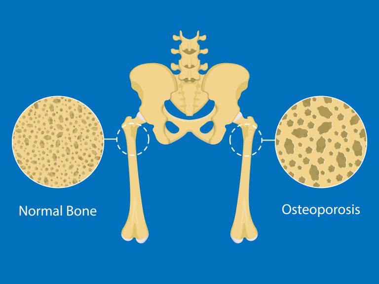 BONE DENSITY TESTING - The Woman's Group Tampa