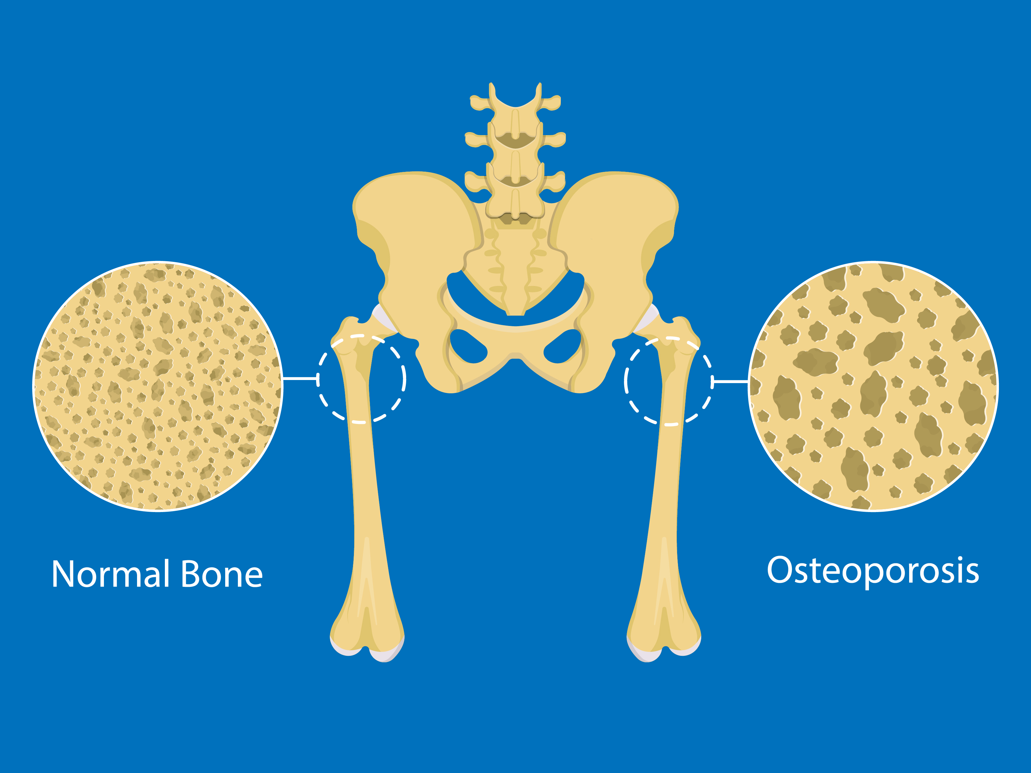 cplot bone density vs age